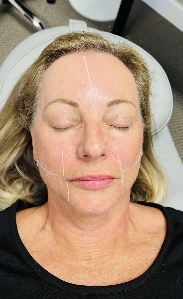 Before Image: Laser Genesis - front