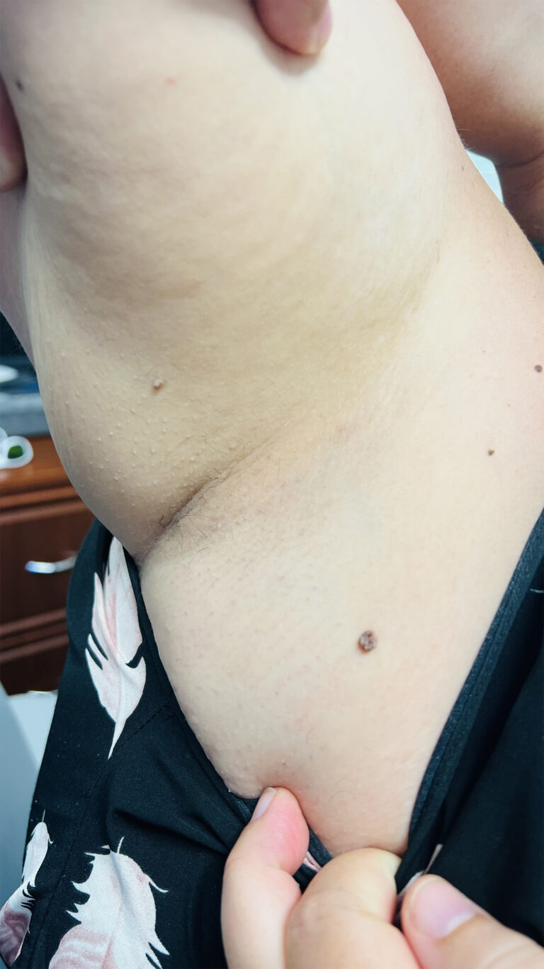 After Image: Laser Hair Removal - front