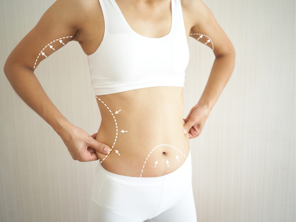 Woman pinching her sides, with arrows pointing to various possible treatment areas for truSculpt ID treatments