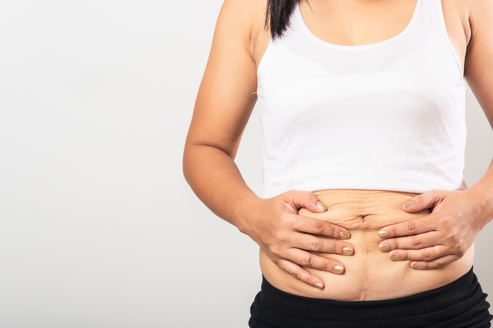 Woman holding her stretch-marked stomach after pregnancy and in need of medical weight loss treatment.