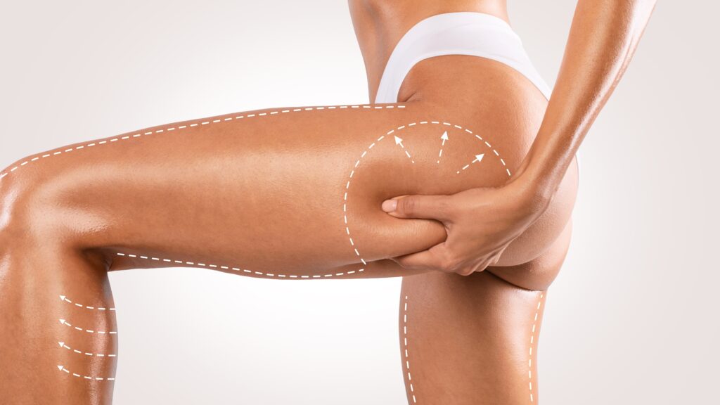 Close up on a woman touching her thigh and squeezing the excess fat there, in need of truSculpt iD